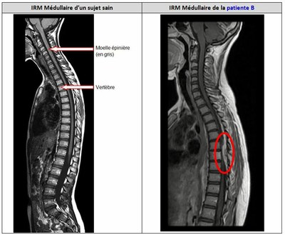 Comparaison IRM Medullaire Patient Sain Et B.JPG — Site Des Ressources ...